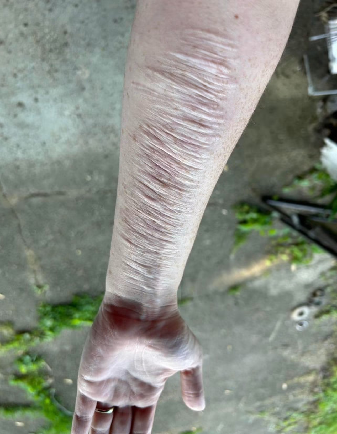 Healed linear scars on a forearm before tattooing