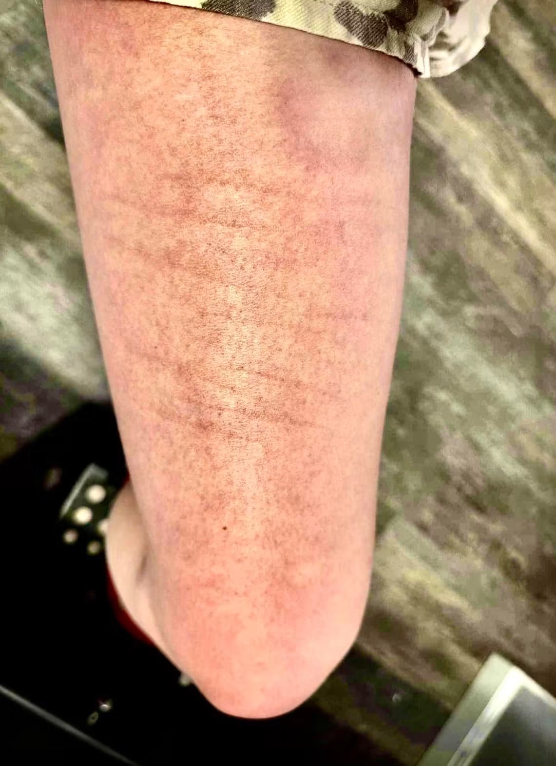 Healed scars on an upper arm before tattooing