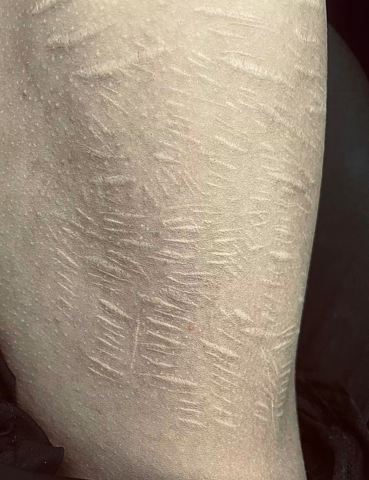 Healed scars on skin before tattooing