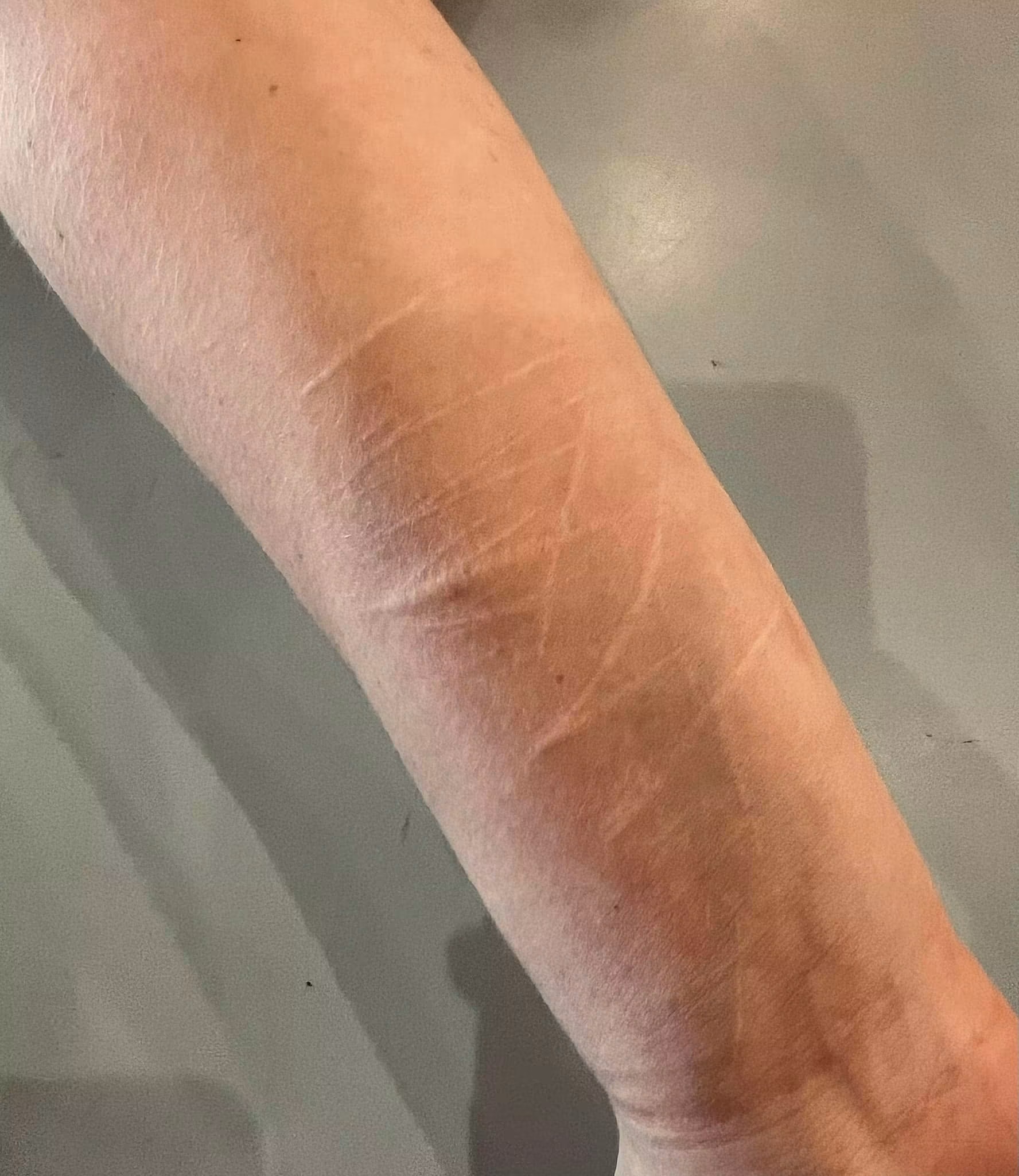 Healed scars on a forearm before tattooing